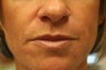 Restylane