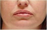Restylane