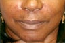 Restylane