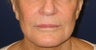 Restylane