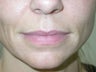Restylane
