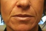 Restylane