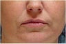 Restylane