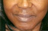 Restylane