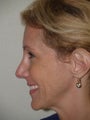 Revision rhinoplasty