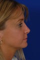 Revision rhinoplasty