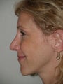 Revision rhinoplasty