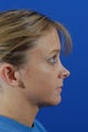 Revision rhinoplasty