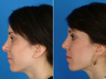 Revision rhinoplasty