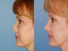 Revision rhinoplasty