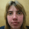Revision rhinoplasty