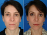 Revision rhinoplasty