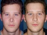 Revision rhinoplasty