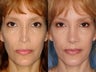 Revision rhinoplasty