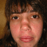 Revision rhinoplasty