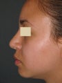 Rhinoplasty