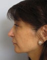 Rhinoplasty