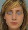 Rhinoplasty