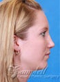 Rhinoplasty