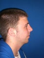 Rhinoplasty