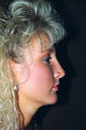 Rhinoplasty