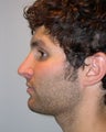 Rhinoplasty