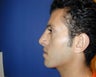 Rhinoplasty