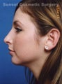 Rhinoplasty