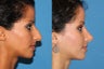 Rhinoplasty