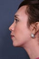 Rhinoplasty