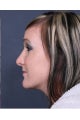 Rhinoplasty