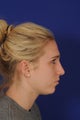 Rhinoplasty