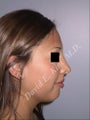 Rhinoplasty