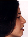 Rhinoplasty