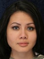 Rhinoplasty