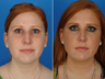 Rhinoplasty