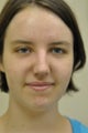 Rhinoplasty