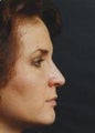 Rhinoplasty