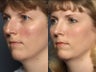 Rhinoplasty