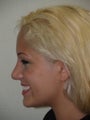 Rhinoplasty