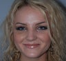 Rhinoplasty