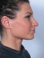 Rhinoplasty