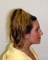 Rhinoplasty