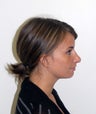 Rhinoplasty