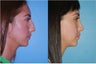 Rhinoplasty