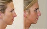 Rhinoplasty
