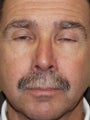 Rhinoplasty