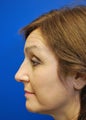Rhinoplasty