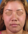Rhinoplasty