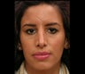 Rhinoplasty